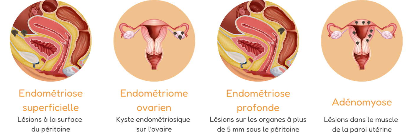 illustrations des différentes formes de l'endométriose