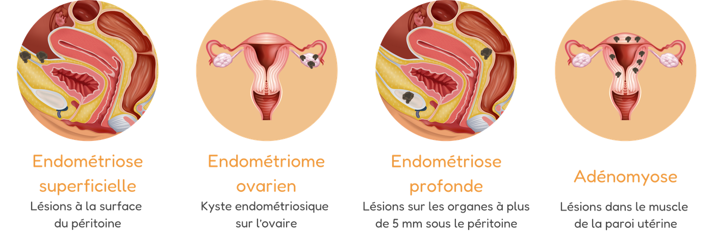 illustrations des différentes formes de l'endométriose