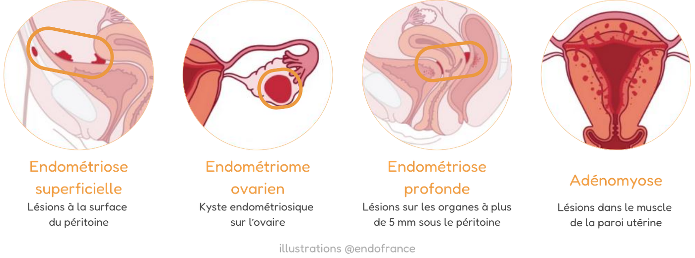 illustrations des différentes formes de l'endométriose