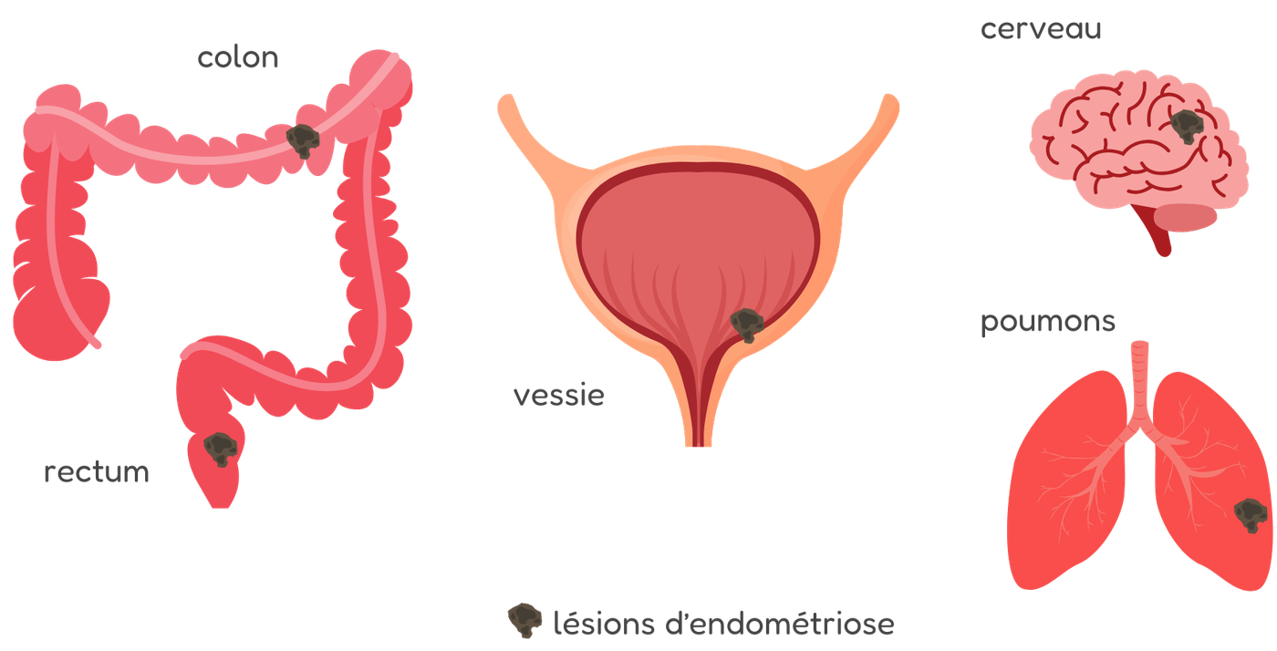 illustrations de lésions d'endométriose sur différents organes