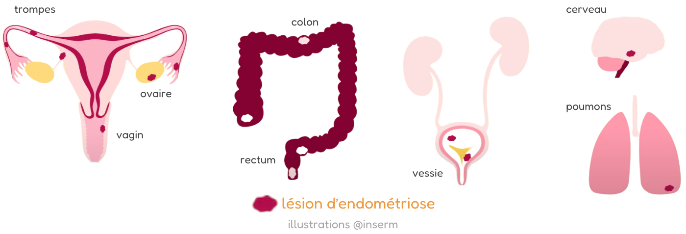 illustrations de lésions d'endométriose sur différents organes