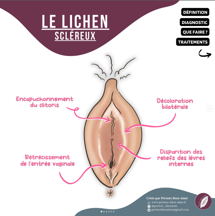 lychen scléreux post instagram de périnée bien aimé