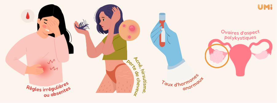 critères de diagnostic du SOPK endocrinologue